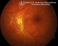 Neovascularization of the disc (NVD)